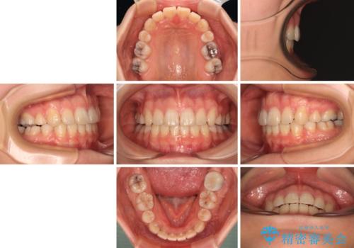 口元の突出感を抜歯矯正で改善 メタル装置で費用を抑えるの治療後