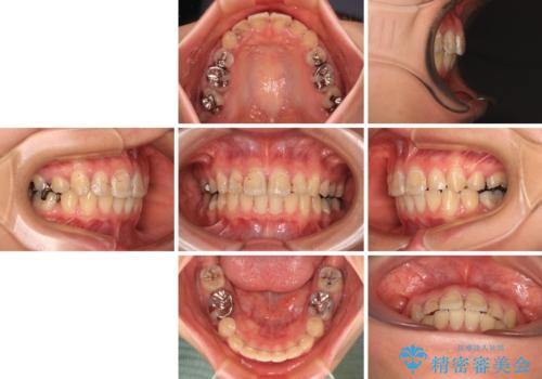 前に飛び出した前歯を治したい ワイヤー装置による抜歯矯正治療の治療後