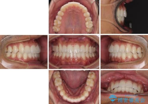 前歯のデコボコを治したい インビザライン矯正治療の治療後
