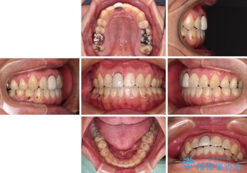 前歯のデコボコとクロスバイトをインビザライン矯正で改善の治療後