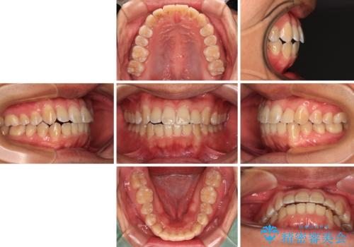 前歯のデコボコを費用を抑えたメタルブラケットできれいにの治療後
