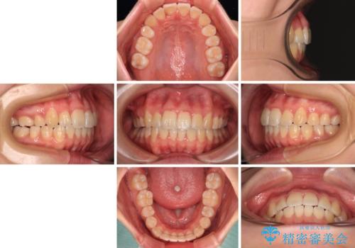 【モニター】八重歯を片側の抜歯矯正で治す メタルブラケット装置の治療後