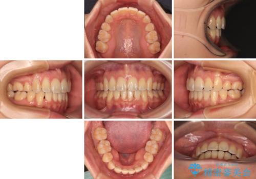 閉じにくい口元を抜歯矯正ですっきりとの治療後