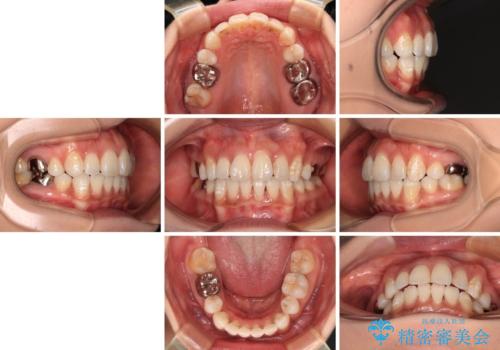 ワイヤー装置の抜歯矯正で横顔の口元の印象をすっきりとの治療後