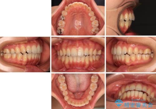 残存乳歯とオープンバイト インビザラインによる矯正治療の治療後