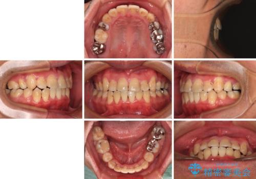 デコボコを治したい 八重歯の抜歯矯正の治療後