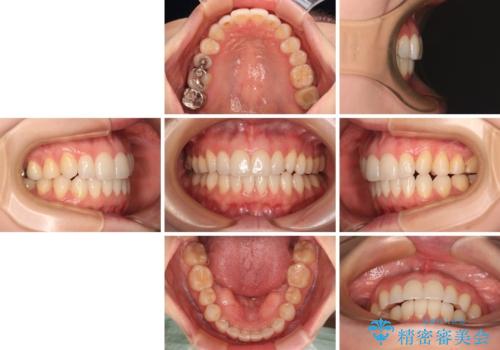 前歯のデコボコをインビザラインで改善の治療後