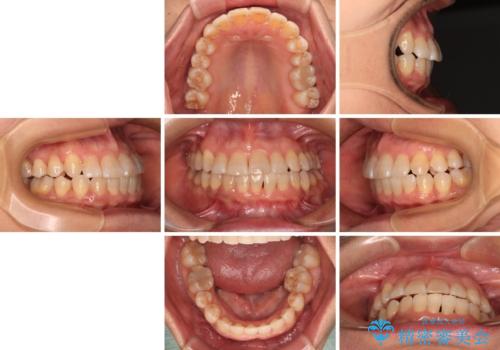 骨格のずれをカムフラージュ クロスバイトのワイヤー矯正の治療後