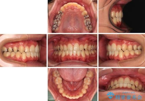 前歯のクロスバイト インビザラインによる矯正治療の治療前