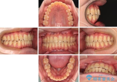 【モニター】前歯のデコボコとクロスバイト ワイヤー矯正で短期間に仕上げるの治療後