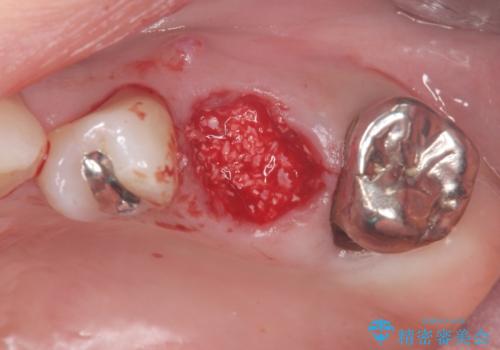 歯槽堤保存を行ったブリッジ治療の治療中