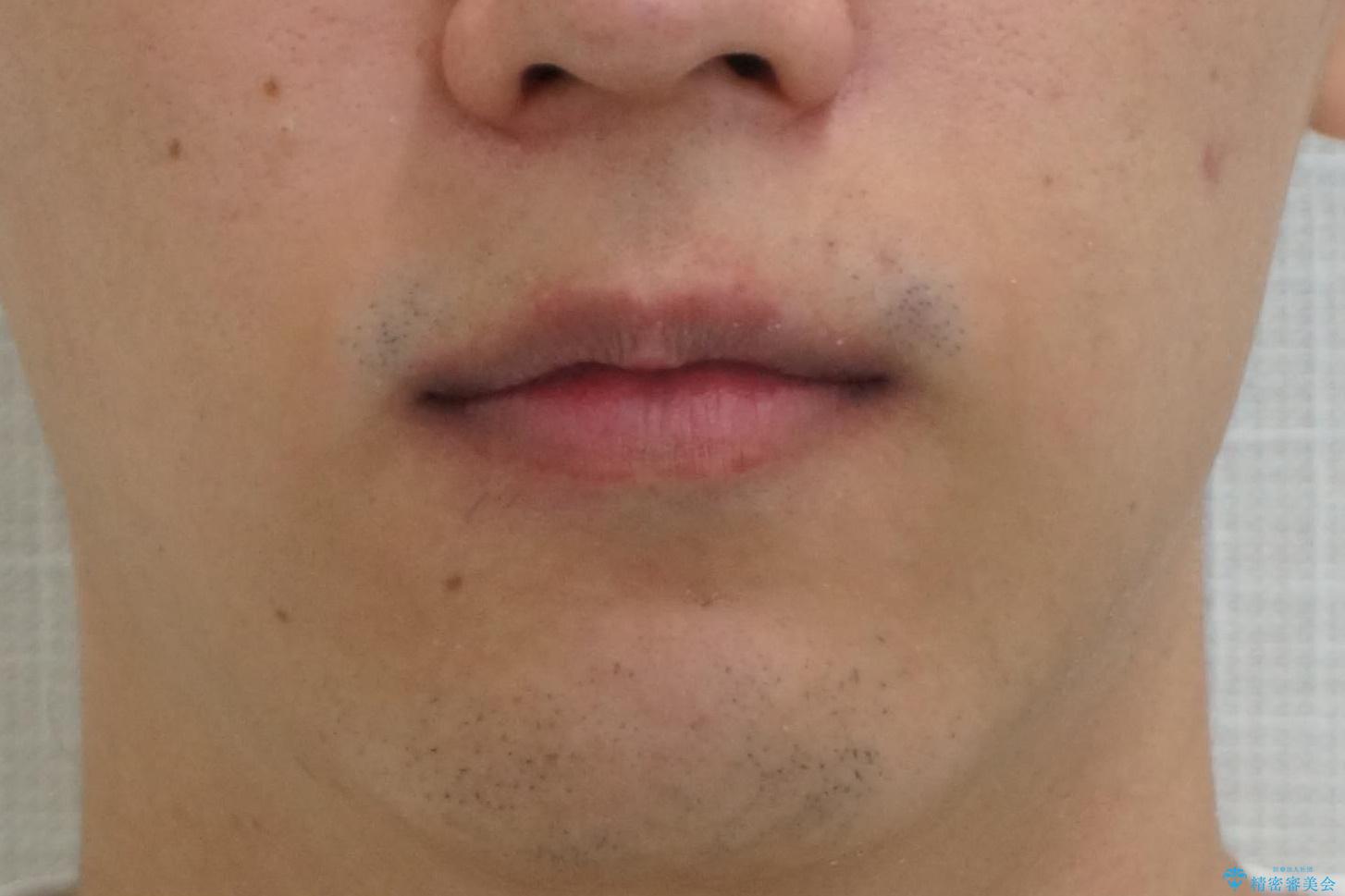 前歯のがたつき 下の八重歯の治療後(顔貌)