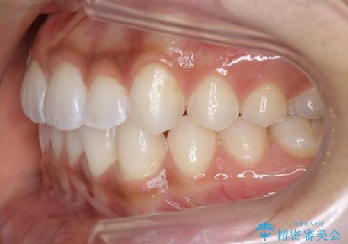 前歯のがたつき　1年かからず治療　マウスピース矯正の治療後
