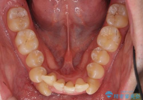 前歯のがたつき 下の八重歯の治療前