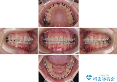 【モニター】再矯正でデコボコの前歯を改善 抜歯矯正の後戻りの治療中