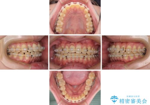 【モニター】前歯のデコボコとクロスバイト ワイヤー矯正で短期間に仕上げるの治療中