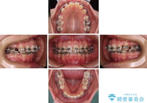 口元の突出感を抜歯矯正で改善　メタル装置で費用を抑えるの治療中