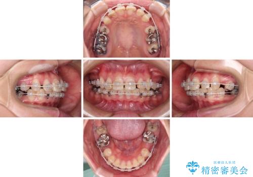 前に飛び出した前歯を治したい ワイヤー装置による抜歯矯正治療の治療中