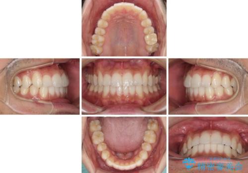 前歯のデコボコを治したい インビザライン矯正治療の治療中