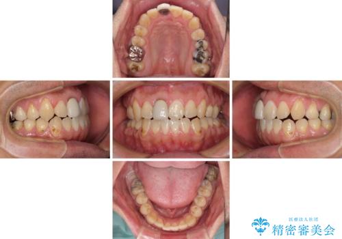 前歯のデコボコとクロスバイトをインビザライン矯正で改善の治療中