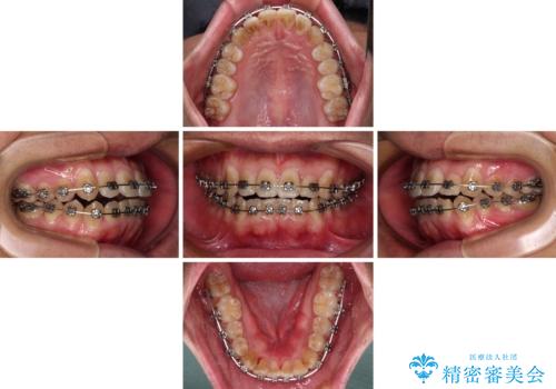 前歯のデコボコを費用を抑えたメタルブラケットできれいにの治療中