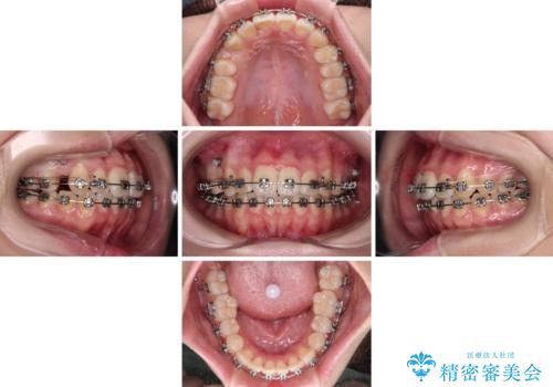 【モニター】八重歯を片側の抜歯矯正で治す メタルブラケット装置の治療中