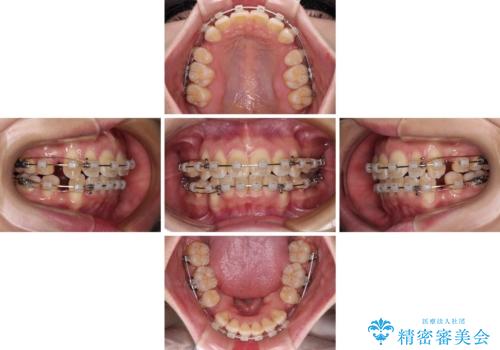 閉じにくい口元を抜歯矯正ですっきりとの治療中
