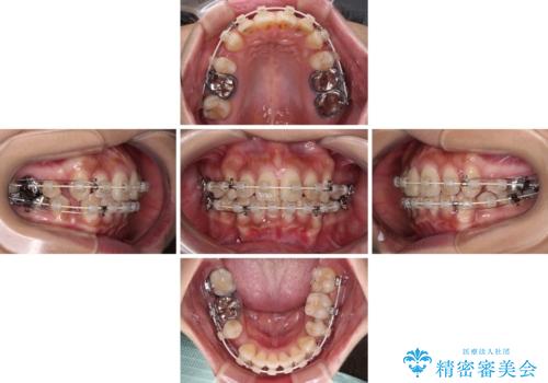ワイヤー装置の抜歯矯正で横顔の口元の印象をすっきりとの治療中