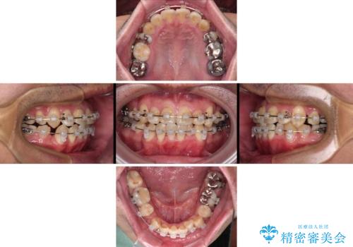 デコボコを治したい 八重歯の抜歯矯正の治療中