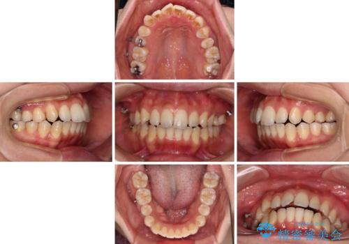 残存乳歯とオープンバイト インビザラインによる矯正治療の治療中