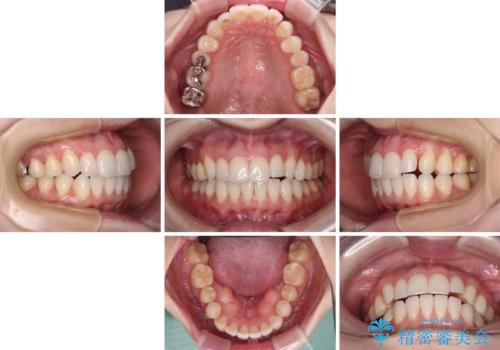 前歯のデコボコをインビザラインで改善の治療中