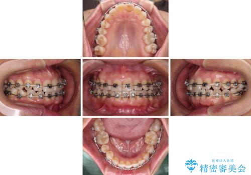 骨格のずれをカムフラージュ クロスバイトのワイヤー矯正の治療中