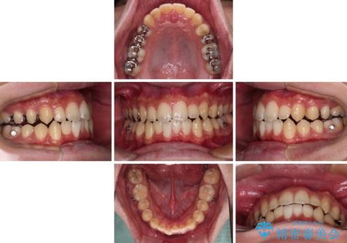 前歯のクロスバイト インビザラインによる矯正治療の治療中