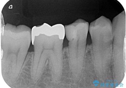 歯と歯の間によくものが詰まる。。セラミック治療の治療前