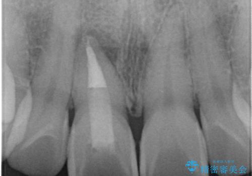 [ 前歯のセラミック治療 ]  変色した前歯を綺麗にしたいの治療中