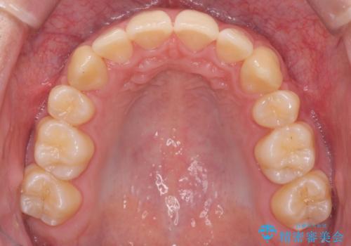 前歯のがたつき 下の八重歯の治療後