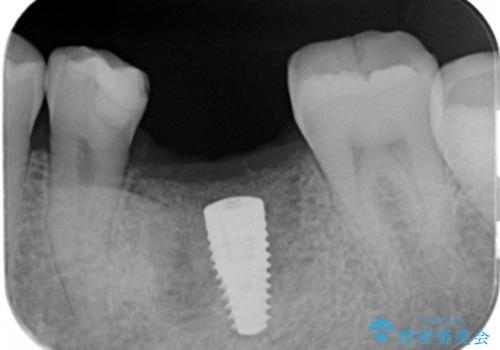 インプラントによる咬合機能回復の治療中