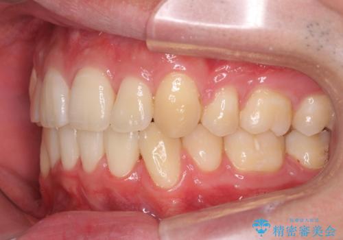 前歯のがたつき　下の八重歯の治療後