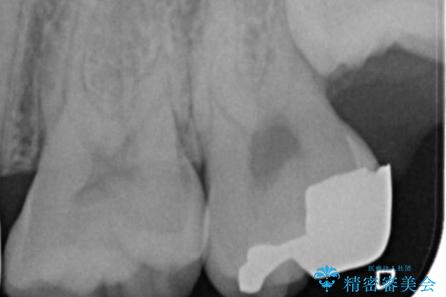歯ぐきの形を整え、外れにくい被せ物を装着の治療前