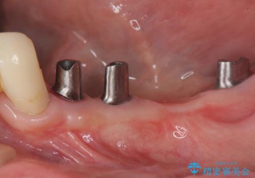[ 重度歯周病 ]　抜歯後のインプラント治療の治療中