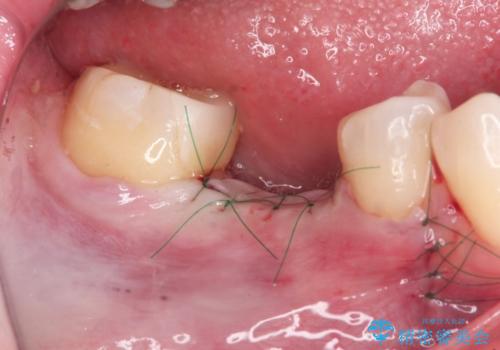 失った歯のインプラント補綴の治療中