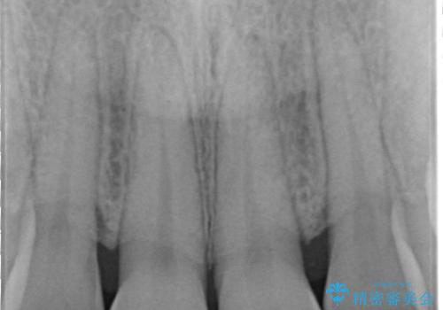 前歯の形気になる セラミッククラウン(SP)の治療前