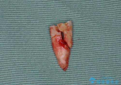 強い咬合力クリアランスの問題を解決したメタルボンドブリッジ治療の治療中