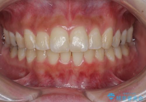 [ 出っ歯を治したい ]　マイクロインプラントを用いた大きな後方移動の症例 治療後