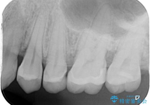 歯が欠けた セラミックインレーの治療前