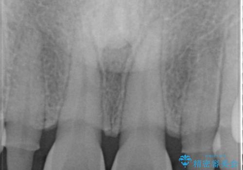 歯の形気になる!! セラミック治療 前歯( エクセレント)の治療前