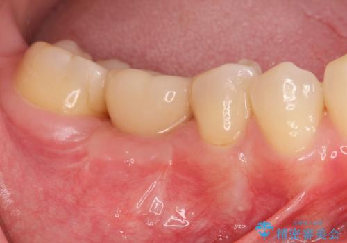 失った歯のインプラント補綴の症例 治療後