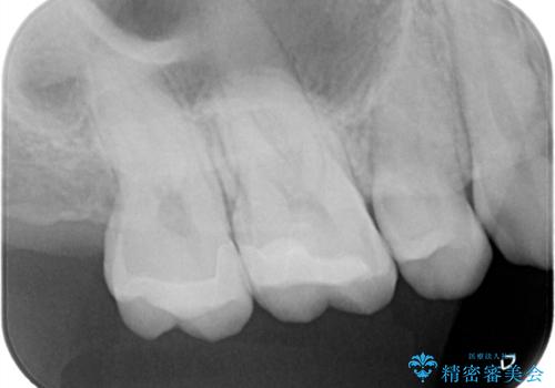 【メタルフリー】金属を白くしたい。の治療後