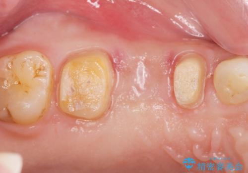 強い咬合力クリアランスの問題を解決したメタルボンドブリッジ治療の治療中