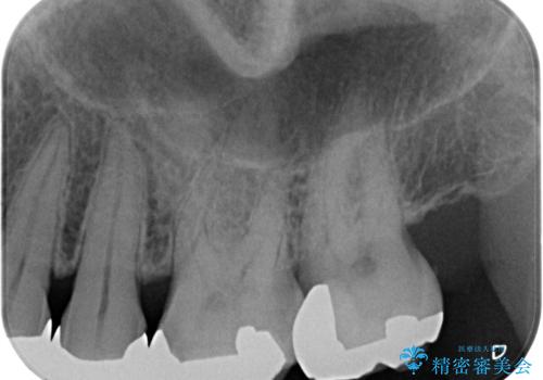奥歯の虫歯 ゴールドインレーでの修復処置の治療後